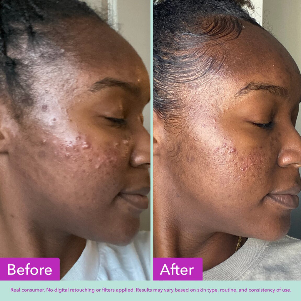 acne-foaming-cleanser-t8 zb_p.jpg